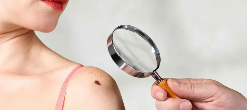 Cómo examinar tu piel para detectar cáncer si tienes un tono de piel más oscuro