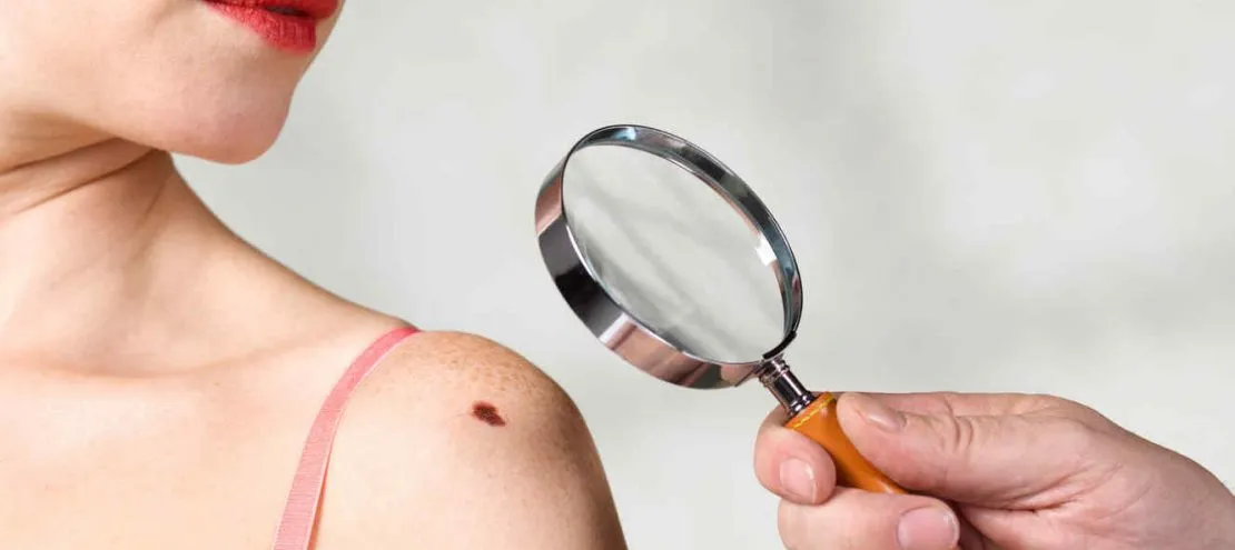 Cómo examinar tu piel para detectar cáncer si tienes un tono de piel más oscuro