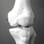 Exploring the Long-Term Effects of Menopause on Bone Health