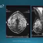 Lo que debes saber sobre las biopsias de mama