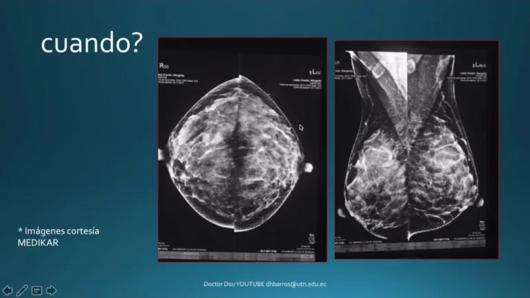 Lo que debes saber sobre las biopsias de mama