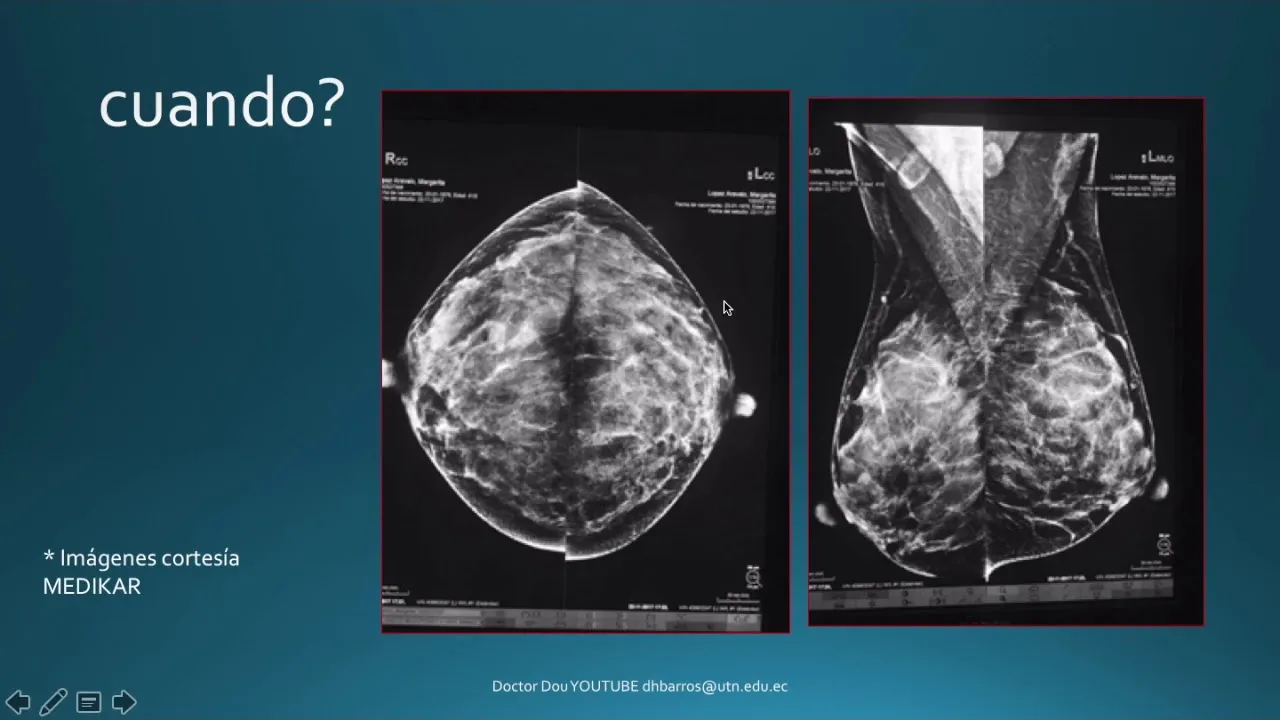 Lo que debes saber sobre las biopsias de mama