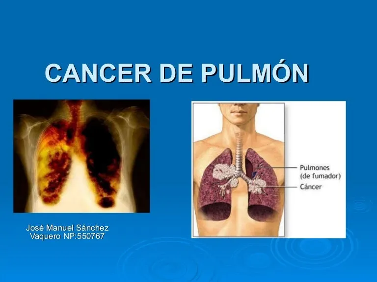 Nunca fumé pero tengo cáncer pulmonar de etapa 4