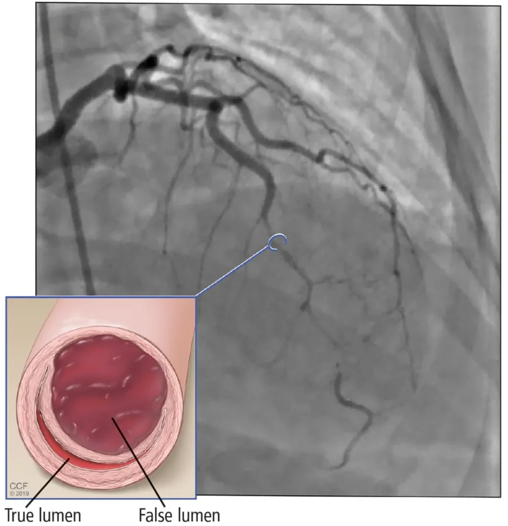 Spontaneous Coronary Artery Dissection 101 Spontaneous Coronary Artery Dissection 101
