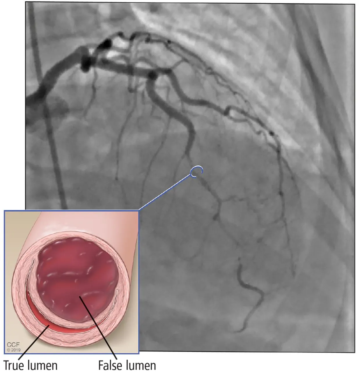 Spontaneous Coronary Artery Dissection 101