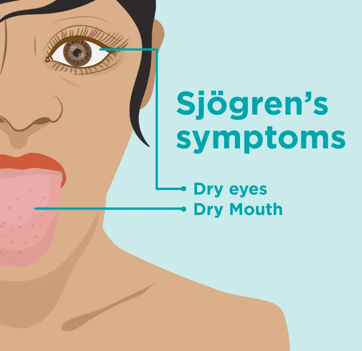 What Is Sjögren’s Disease? – HealthyWomen