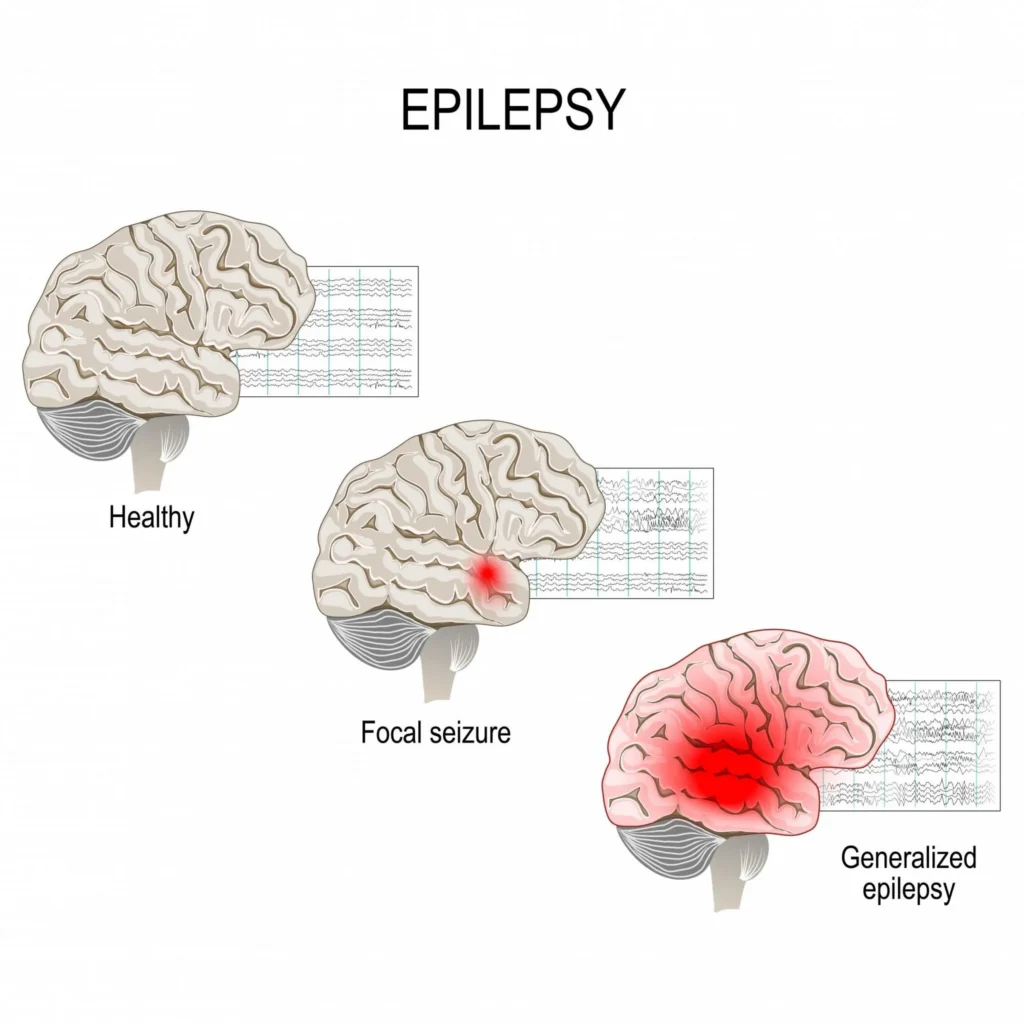 The Science Behind Keto and Epilepsy: How It Works to Reduce Seizures The Science Behind Keto and Epilepsy: How It Works to Reduce Seizures