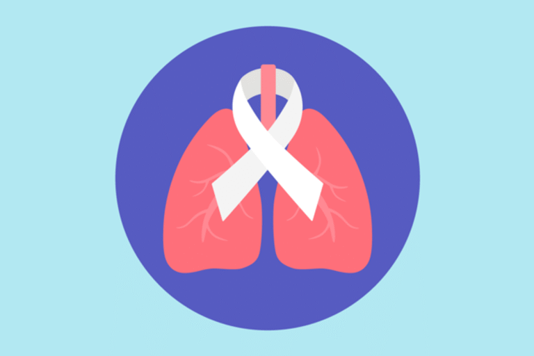 Síntomas de cáncer pulmonar