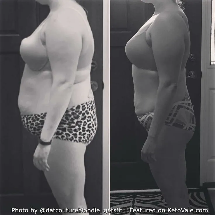 Keto Diet Success Stories: How It’s Changing Lives for Those with Epilepsy