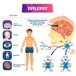 From Seizures to Stability: How the Keto Diet is Transforming Epilepsy Treatment