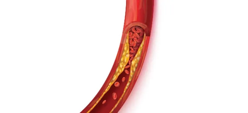 Is Keto Safe for Your Heart Health? Examining the Effects on Cholesterol